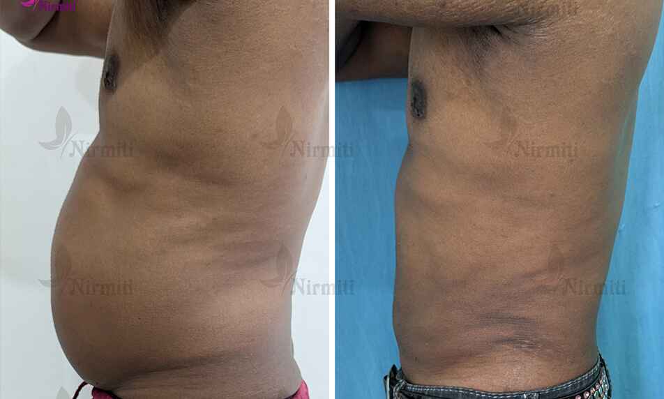 Abdominoplasty Surgery