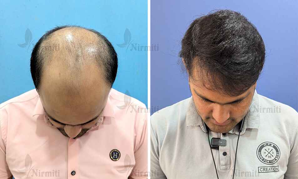 Hair Transplant