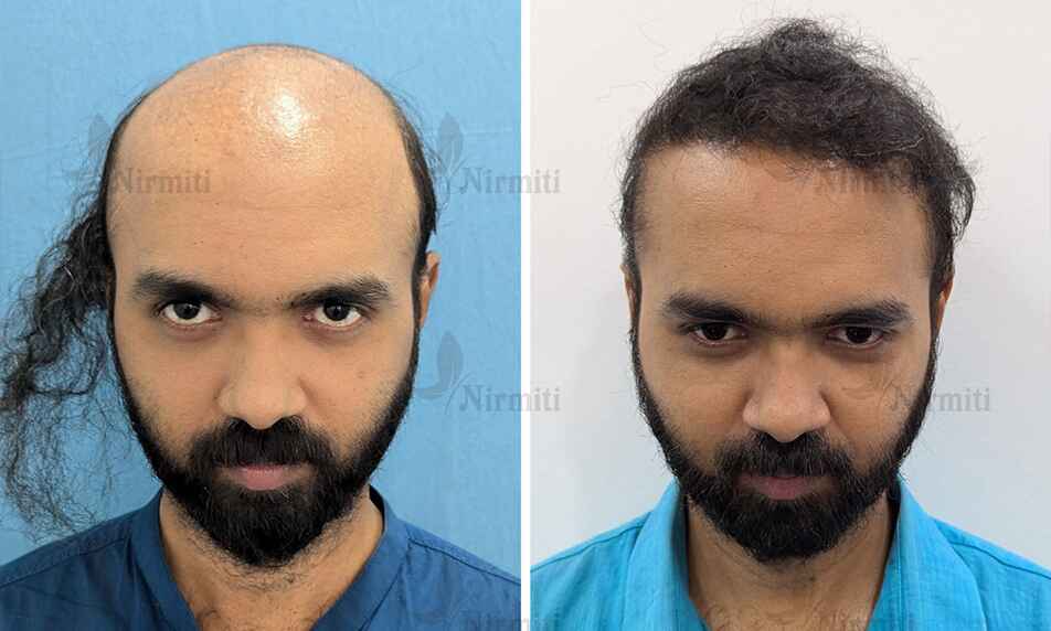 Hair Transplant