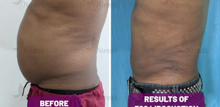 liposuction surgery in Kolhapur