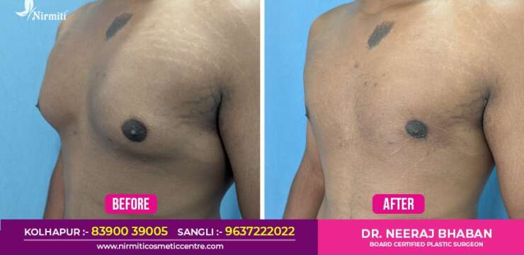 Gynecomastia surgery