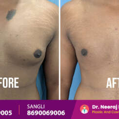 Struggling with ‘Man Boobs’? Here’s How a Top Gynecomastia Surgeon Can Fix It for Good