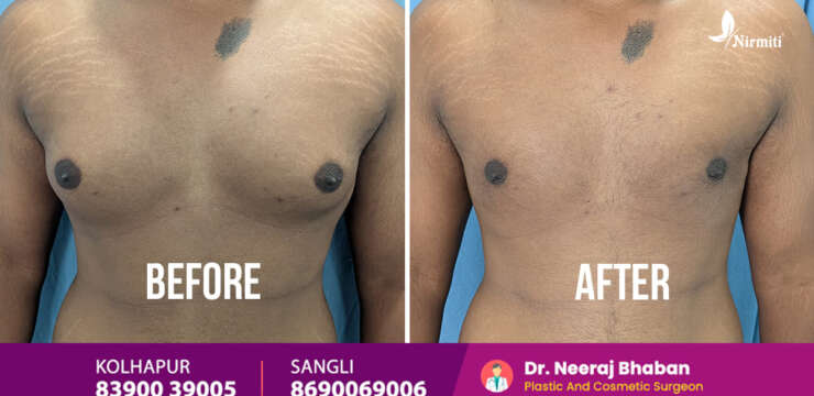 Best Gynecomastia Surgeon