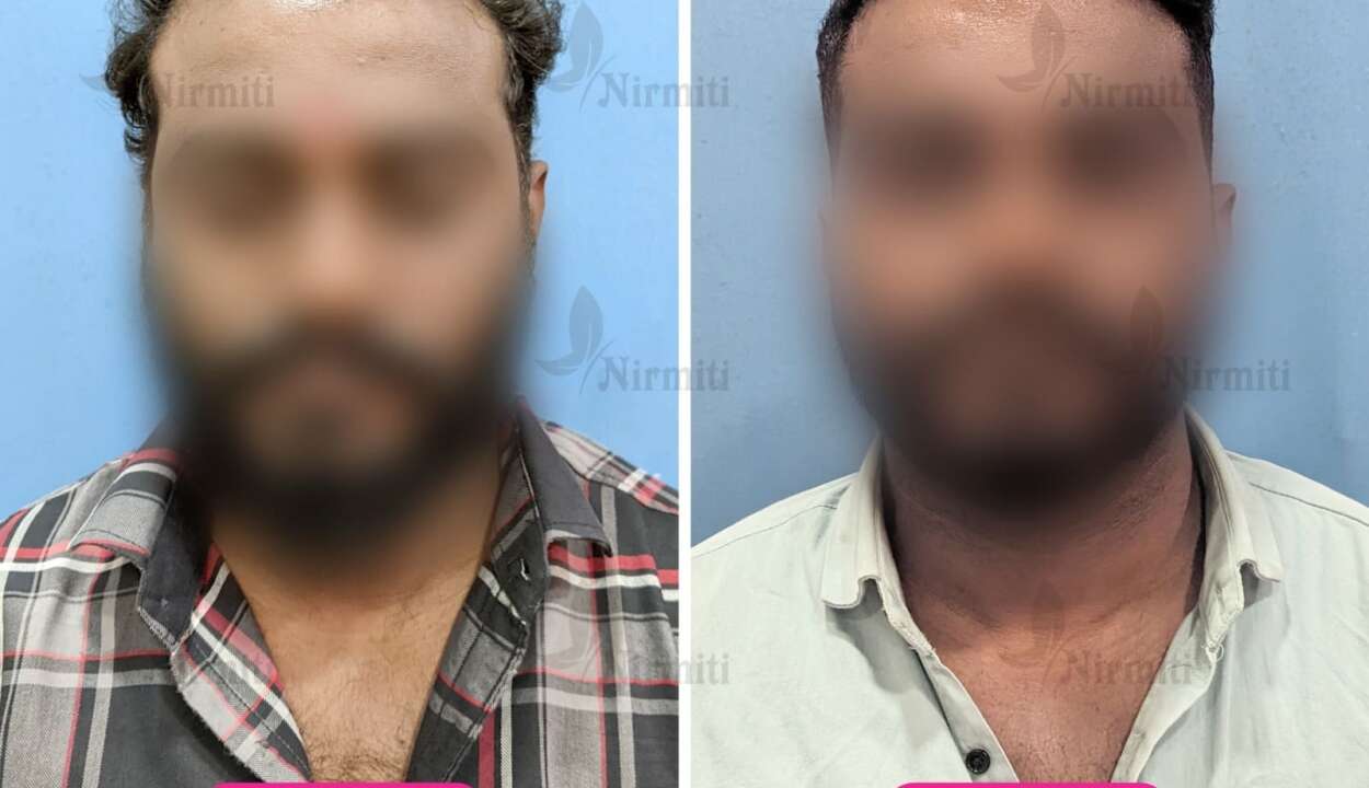Hair Transplant in Sangli