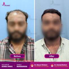 Hair Transplant Before & After: What Really Happens When You Choose the Right Doctor