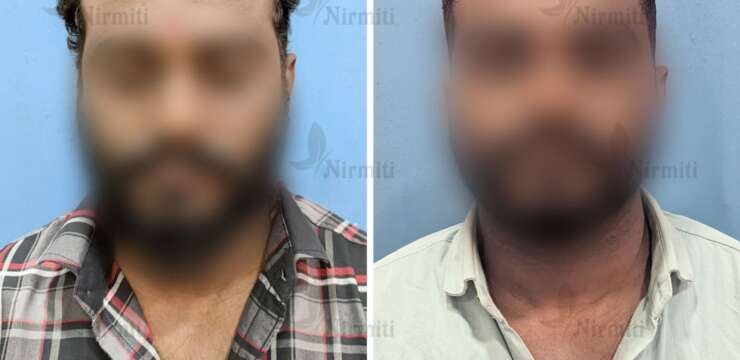 Hair Transplant in Sangli